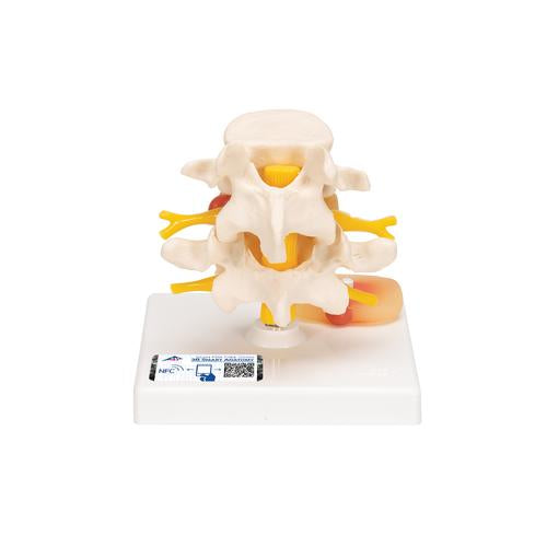 Human Lumbar Spinal Column with Prolapsed Intervertebral Disc - 3B Smart Anatomy