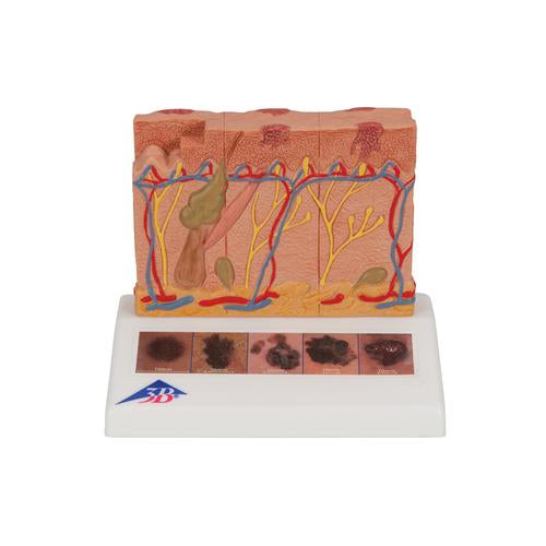 Skin Cancer Model with 5 stages, 8 times magnified - 3B Smart Anatomy
