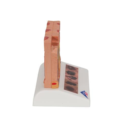Image 4 - SKIN CANCER MODEL WITH 5 STAGES, 8 TIMES MAGNIFIED - 3B SMART ANATOMY