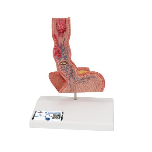 Life-Size Human Esophagus Diseases Model - 3B Smart Anatomy