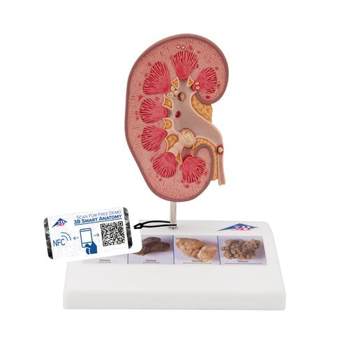 Kidney Stone Model - 3B Smart Anatomy