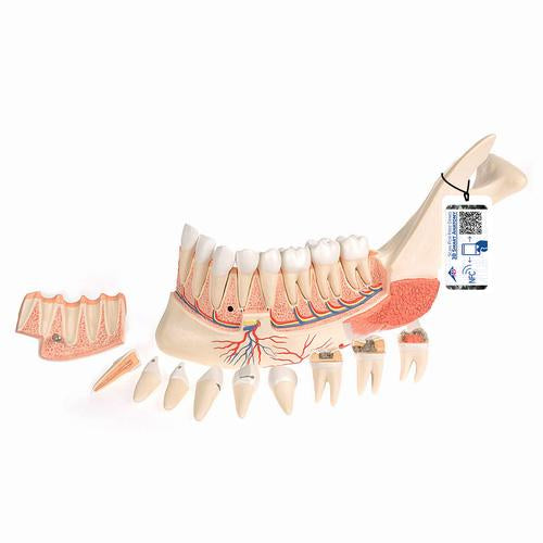 Comprehensive Lower Jaw Model (Left Half) with Diseased Teeth, Nerves, Vessels & Glands, 19 part - 3B Smart Anatomy