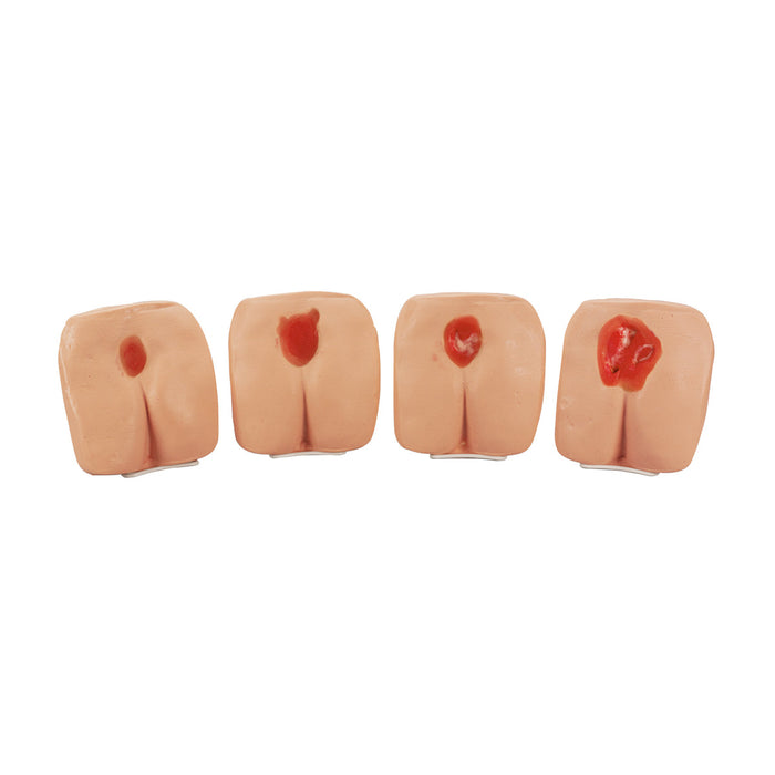 Pressure Ulcer/Bedsore Models, Light