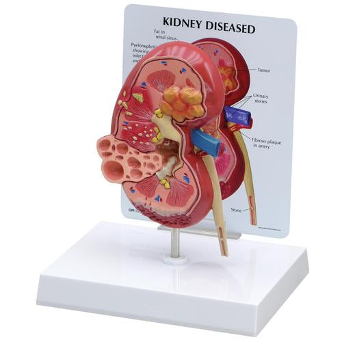 Diseased Kidney Model