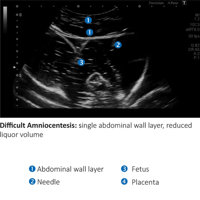Image 2 - AMNIO ABBY® - ULTRASOUND GUIDED INVASIVE PROCEDURES SIMULATOR