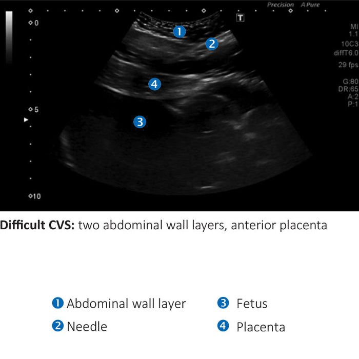 Image 6 - AMNIO ABBY® - ULTRASOUND GUIDED INVASIVE PROCEDURES SIMULATOR