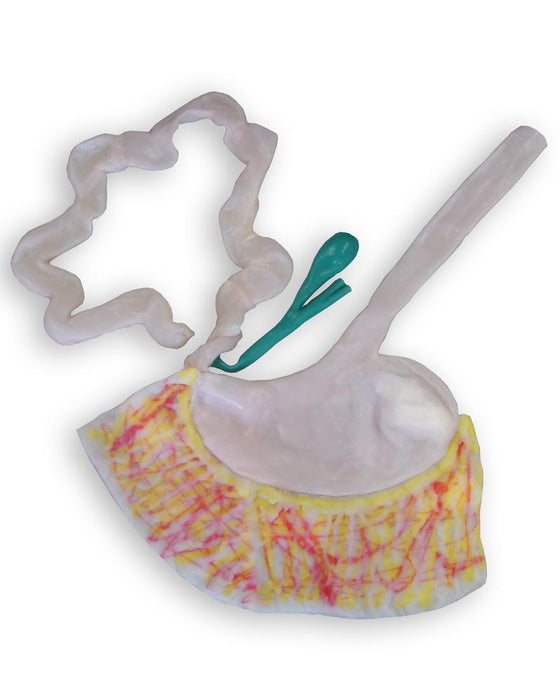 Cholecystenterostomy Replaceable Tissue