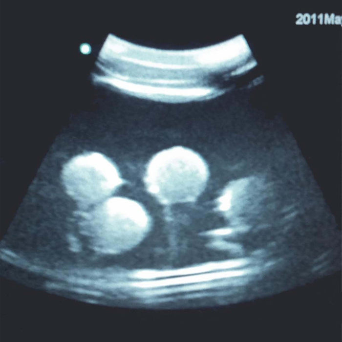 Image 2 - ULTRASOUND PARACENTESIS TRAINING PACKAGE