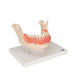 Image 3 - DENTAL DISEASE MODEL, MAGNIFIED 2 TIMES, 21 PARTS - 3B SMART ANATOMY