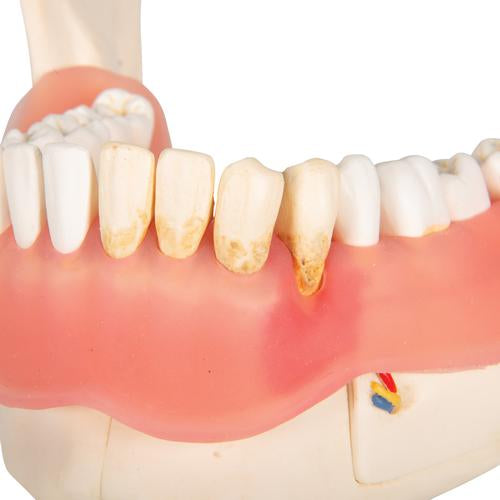 Image 6 - DENTAL DISEASE MODEL, MAGNIFIED 2 TIMES, 21 PARTS - 3B SMART ANATOMY