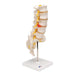 Image 3 - HUMAN LUMBAR SPINAL COLUMN MODEL WITH DORSO-LATERAL PROLAPSED INTERVERTEBRAL DISC - 3B SMART ANATOMY