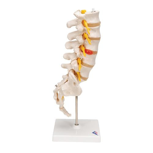 Image 4 - HUMAN LUMBAR SPINAL COLUMN MODEL WITH DORSO-LATERAL PROLAPSED INTERVERTEBRAL DISC - 3B SMART ANATOMY