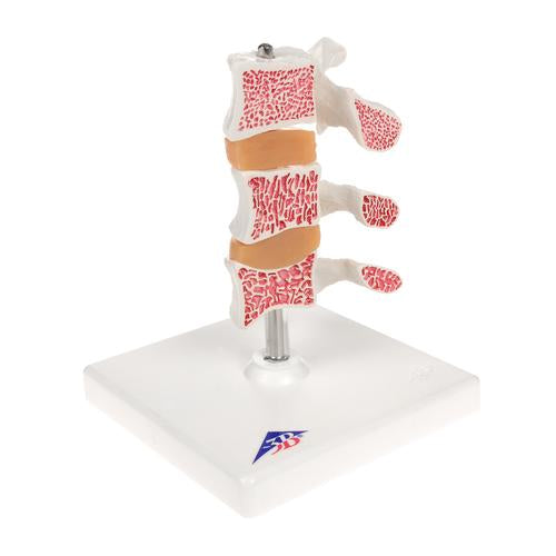 Image 3 - DELUXE HUMAN OSTEOPOROSIS MODEL (3 VERTEBRAE WITH DISCS ), REMOVABLE ON STAND - 3B SMART ANATOMY