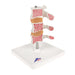 Image 3 - DELUXE HUMAN OSTEOPOROSIS MODEL (3 VERTEBRAE WITH DISCS ), REMOVABLE ON STAND - 3B SMART ANATOMY