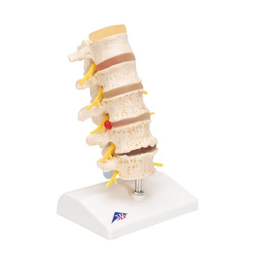 Image 3 - STAGES OF DISC PROLAPSE AND VERTEBRAL DEGENERATION - 3B SMART ANATOMY