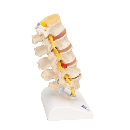 Image 4 - STAGES OF DISC PROLAPSE AND VERTEBRAL DEGENERATION - 3B SMART ANATOMY