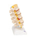 Image 4 - STAGES OF DISC PROLAPSE AND VERTEBRAL DEGENERATION - 3B SMART ANATOMY