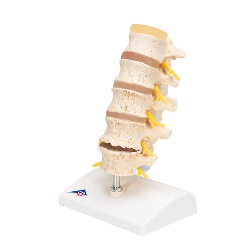 Image 6 - STAGES OF DISC PROLAPSE AND VERTEBRAL DEGENERATION - 3B SMART ANATOMY