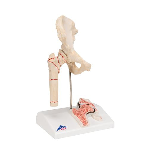 Image 3 - HUMAN FEMORAL FRACTURE & HIP OSTEOARTHRITIS MODEL - 3B SMART ANATOMY