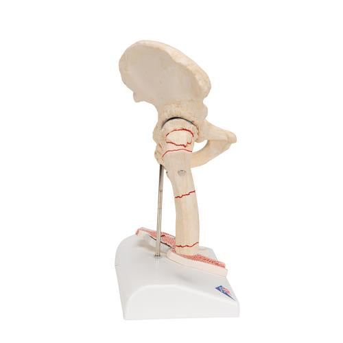 Image 4 - HUMAN FEMORAL FRACTURE & HIP OSTEOARTHRITIS MODEL - 3B SMART ANATOMY