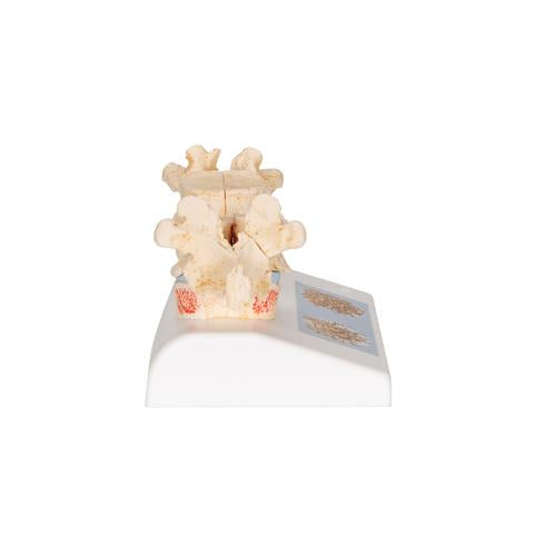 Image 4 - OSTEOPOROSIS DIDACTIC MODEL - 3B SMART ANATOMY