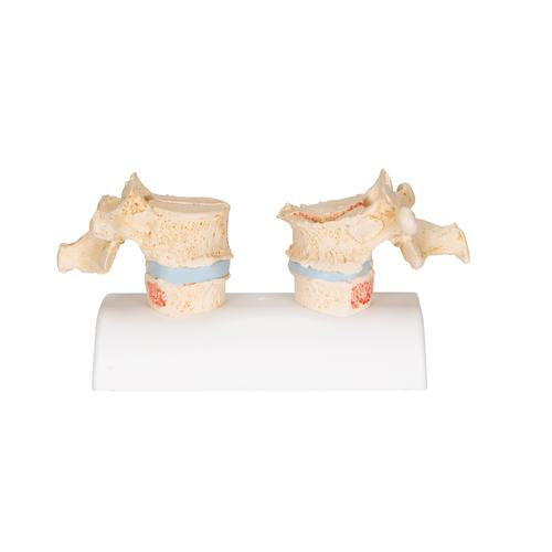 Image 5 - OSTEOPOROSIS DIDACTIC MODEL - 3B SMART ANATOMY