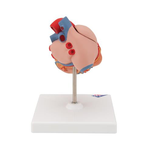 Image 4 - CLASSIC HUMAN HEART MODEL WITH LEFT VENTRICULAR HYPERTROPHY (LVH), 2 PART - 3B SMART ANATOMY