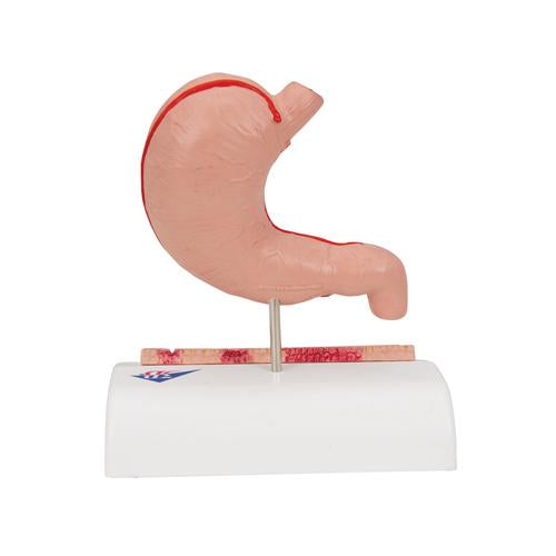 Image 5 - HUMAN STOMACH SECTION MODEL WITH ULCERS - 3B SMART ANATOMY