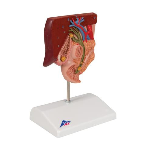 Image 3 - GALLSTONE MODEL - 3B SMART ANATOMY