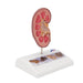 Image 3 - KIDNEY STONE MODEL - 3B SMART ANATOMY