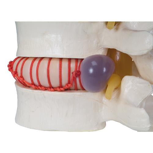 Image 2 - HERNIATED DISC SIMULATOR