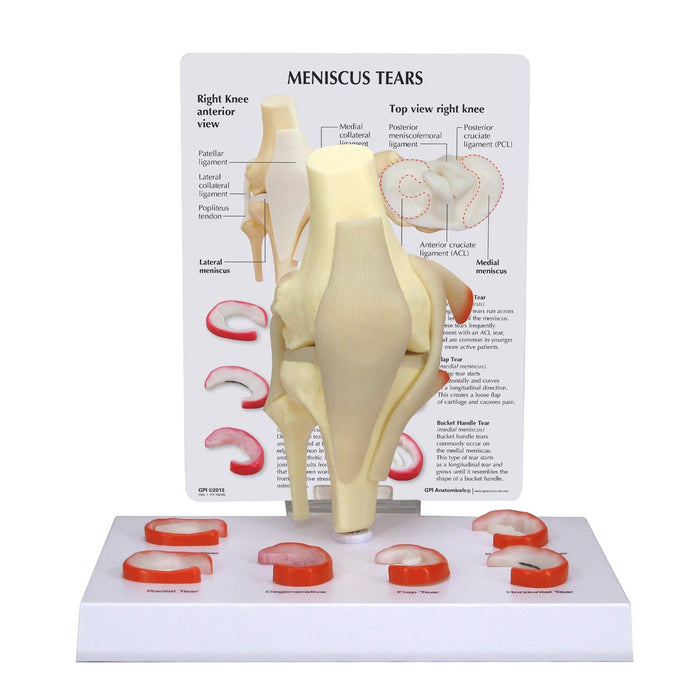 Meniscus Knee Model with 6 Tears