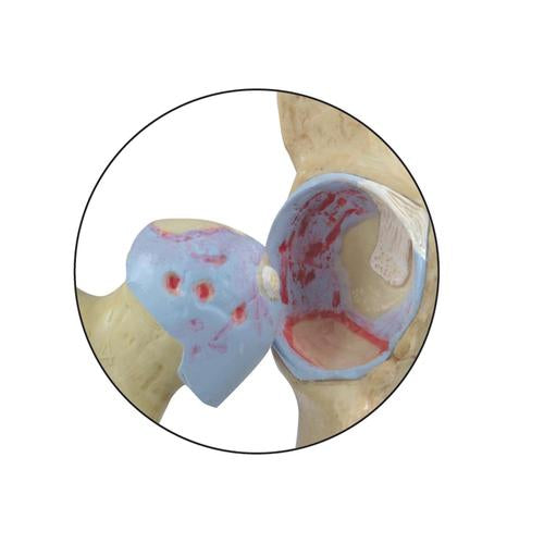 Image 2 - 4-STAGE DEGENERATIVE BONE DISEASES OF THE HIP MODEL