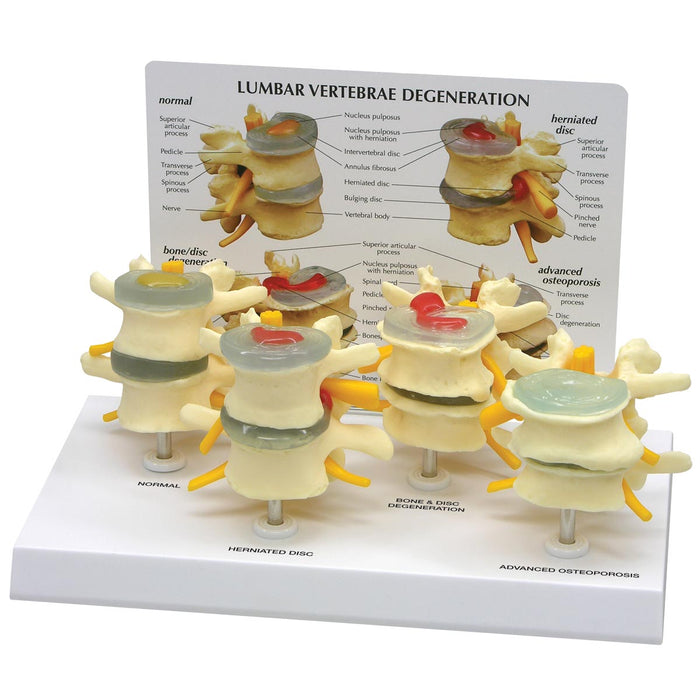 4-Stage Vertebrae Model Set