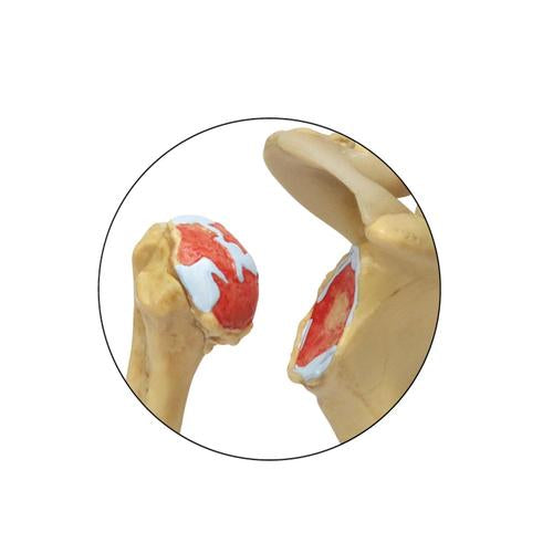 Image 2 - 4 STAGE OSTEOARTHRITIS (OA) SHOULDER MODEL