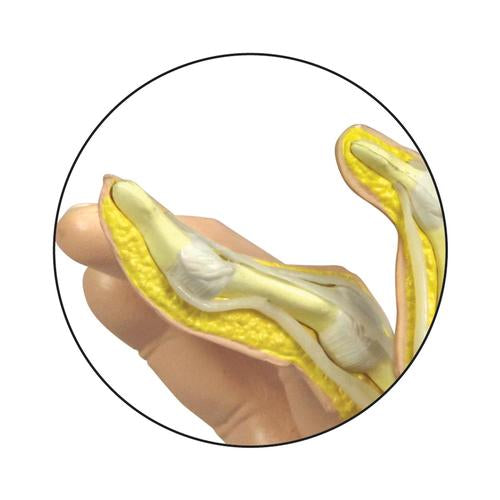 Image 3 - RHEUMATOID ARTHRITIS HAND MODEL