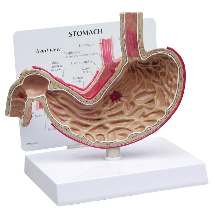 Stomach Model with Ulcers