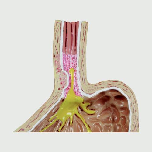 Image 2 - 4-PC GERD - (GASTRO ESOPHAGEAL REFLUX DISEASE)