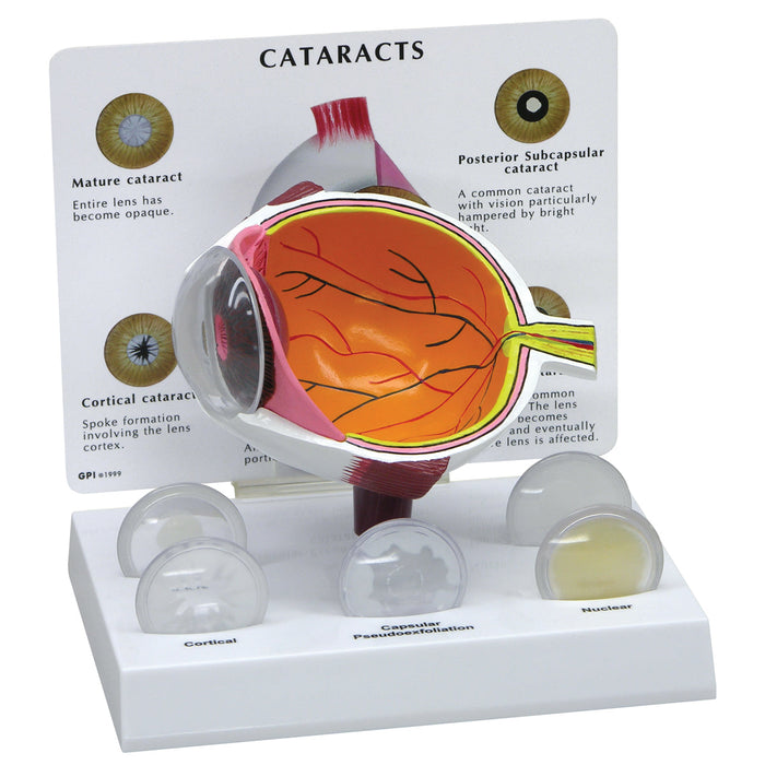 Cataract Eye