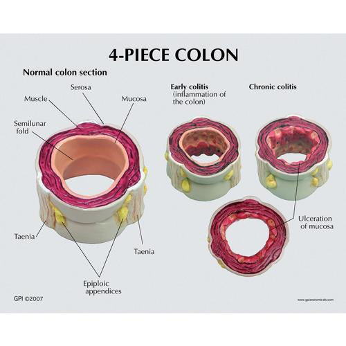 Image 3 - 4 PIECE COLON WITH PATHOLOGIES