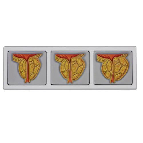 Image 2 - MALE PELVIS WITH 3D PROSTATE FRAME