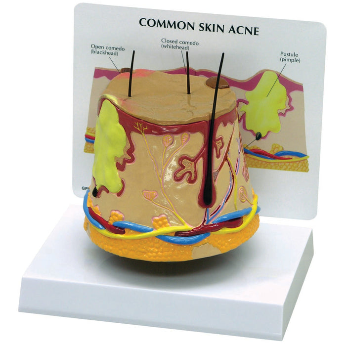 Skin Acne Model (oversize)