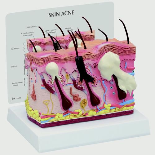 Image 2 - SKIN ACNE MODEL, 2 SIDED