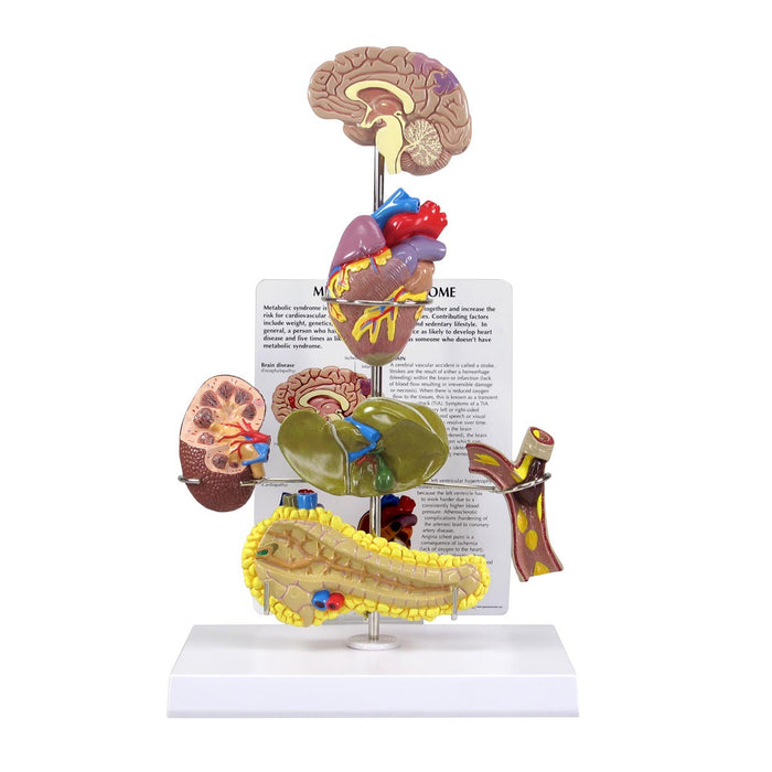 Metabolic Syndrome Model