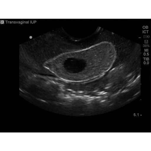 Image 2 - COMBINATION IUP ECTOPIC PREGNANCY TRANSVAGINAL ULTRASOUND TRAINING MODEL