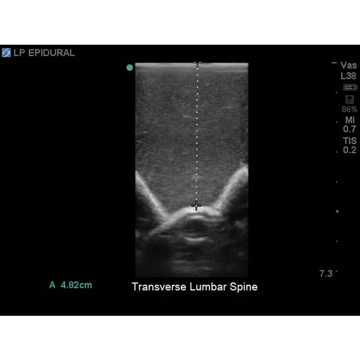 Image 3 - LUMBAR PUNCTURE AND SPINAL EPIDURAL WITH THORACIC EPIDURAL ULTRASOUND TRAINING MODEL