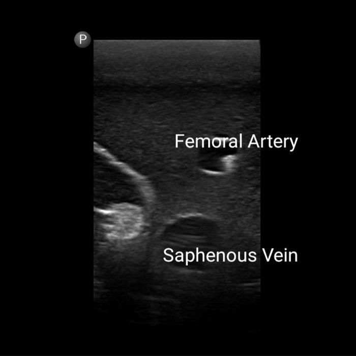 Image 4 - GEN II FEMORAL VASCULAR ACCESS AND REGIONAL ANESTHESIA ULTRASOUND TRAINING MODEL