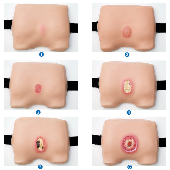 Image 2 - BED SORE TREATMENT MODEL