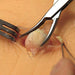 Image 2 - SEBACEOUS CYST PAD