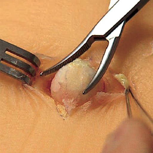 Image 2 - SEBACEOUS CYST PAD